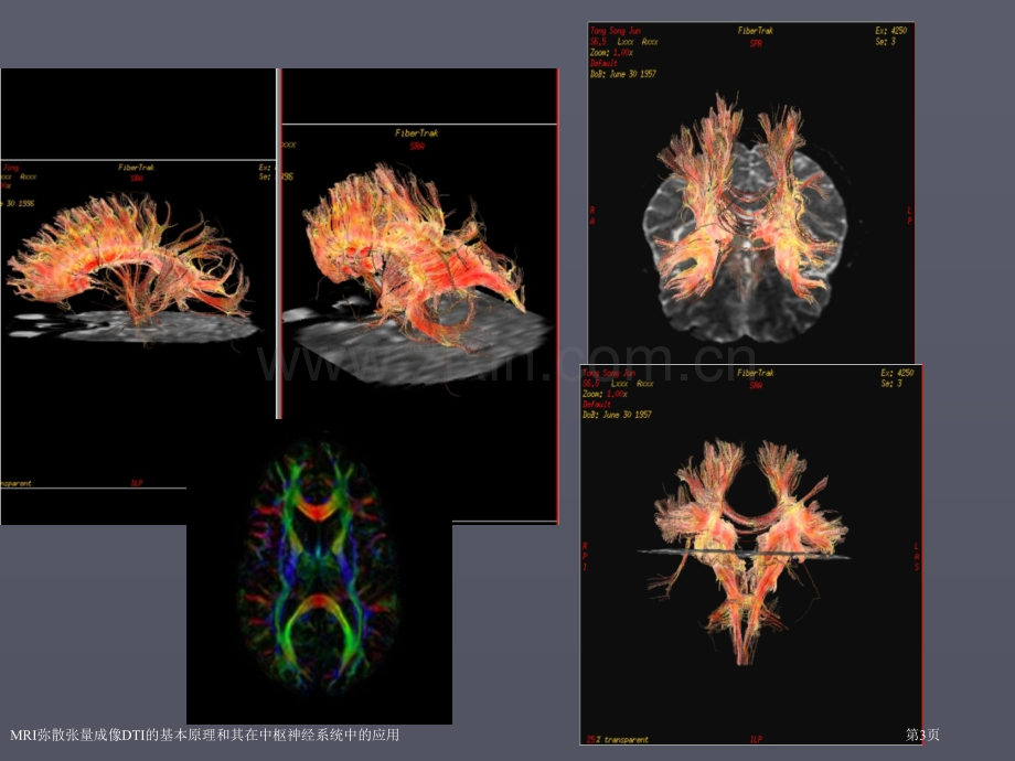 MRI弥散张量成像DTI的基本原理和其在中枢神经系统中的应用医学课件.pptx_第3页