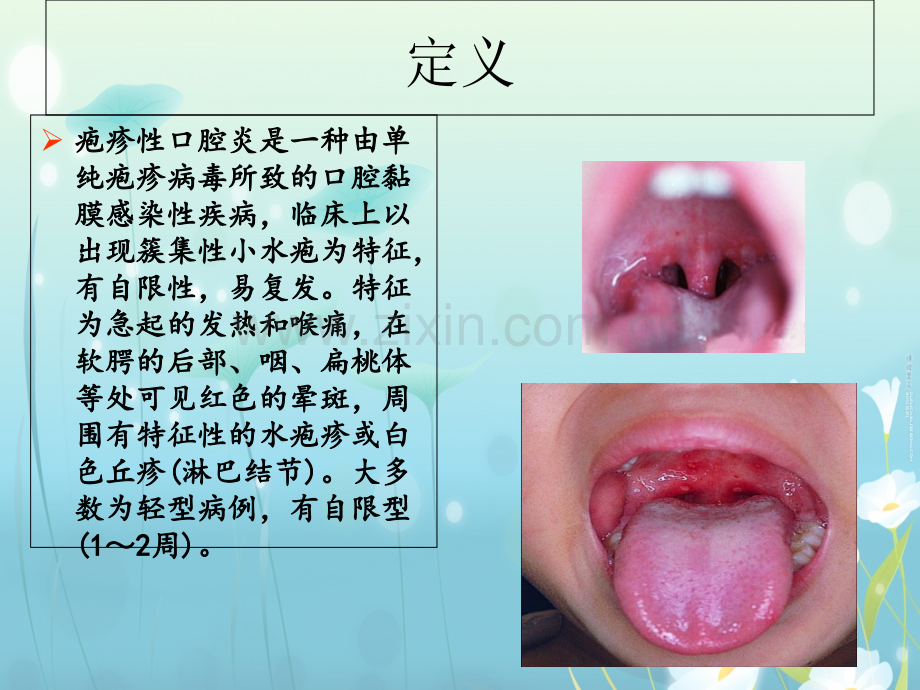 疱疹性咽峡炎PPT优质课件.ppt_第2页