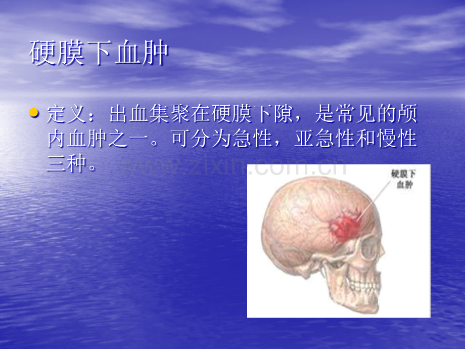 硬膜下血肿的护理查房PPT培训课件.ppt_第3页