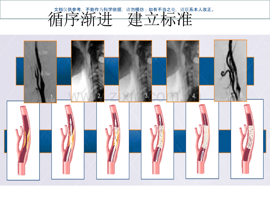 颈动脉支架手术步课件.ppt_第1页