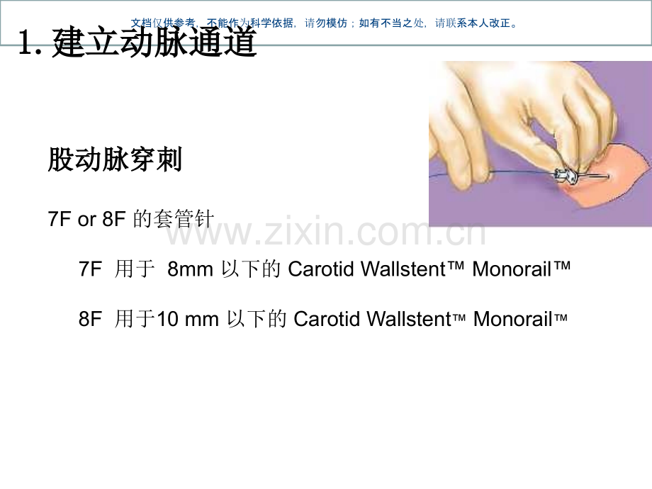 颈动脉支架手术步课件.ppt_第2页