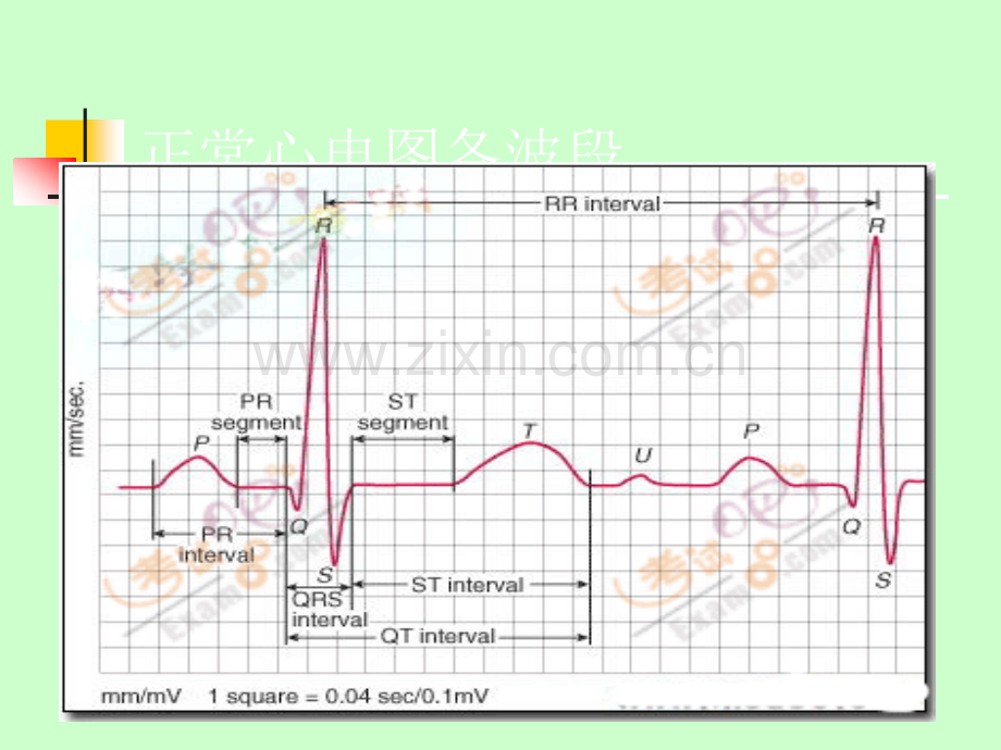 常见病心电图表现.ppt_第2页