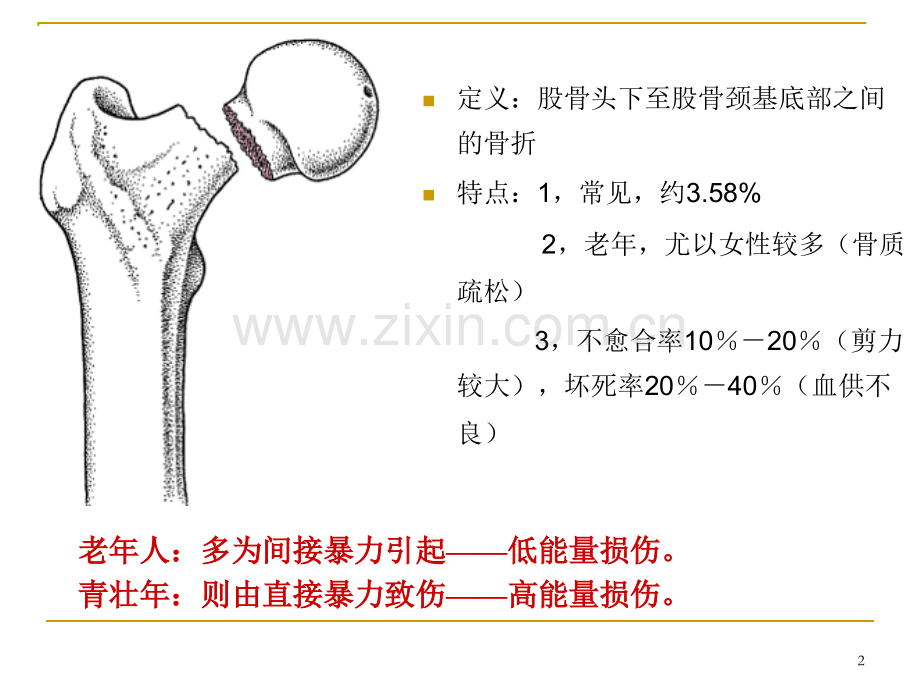 股骨颈骨折护理查房-ppt课件.ppt_第2页