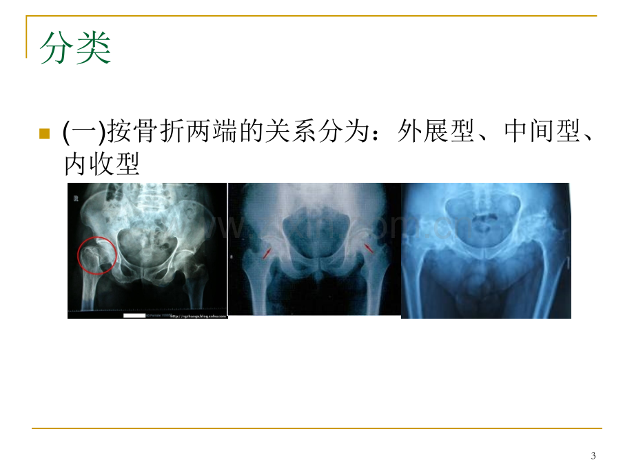 股骨颈骨折护理查房-ppt课件.ppt_第3页