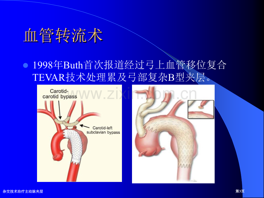 杂交技术治疗主动脉夹层.pptx_第3页