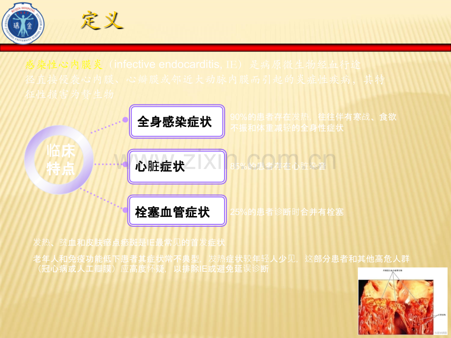 感染性心内膜炎-ppt课件.ppt_第2页