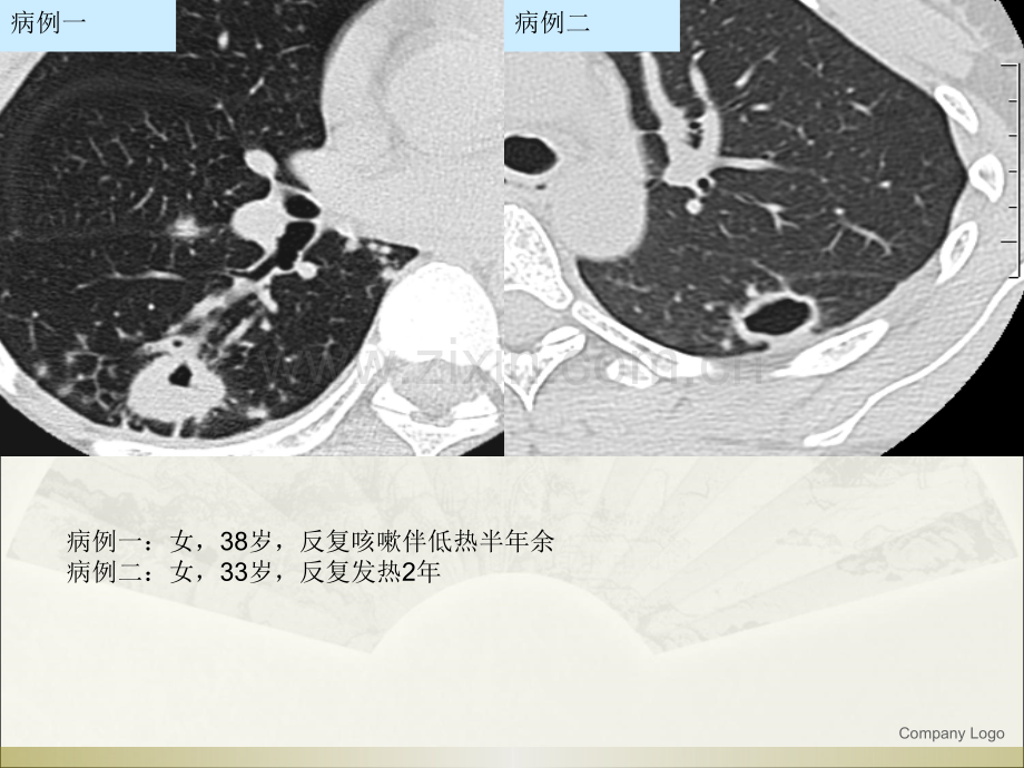 肺结核---球形结核的影像诊断与鉴别诊断ppt课件.ppt_第2页