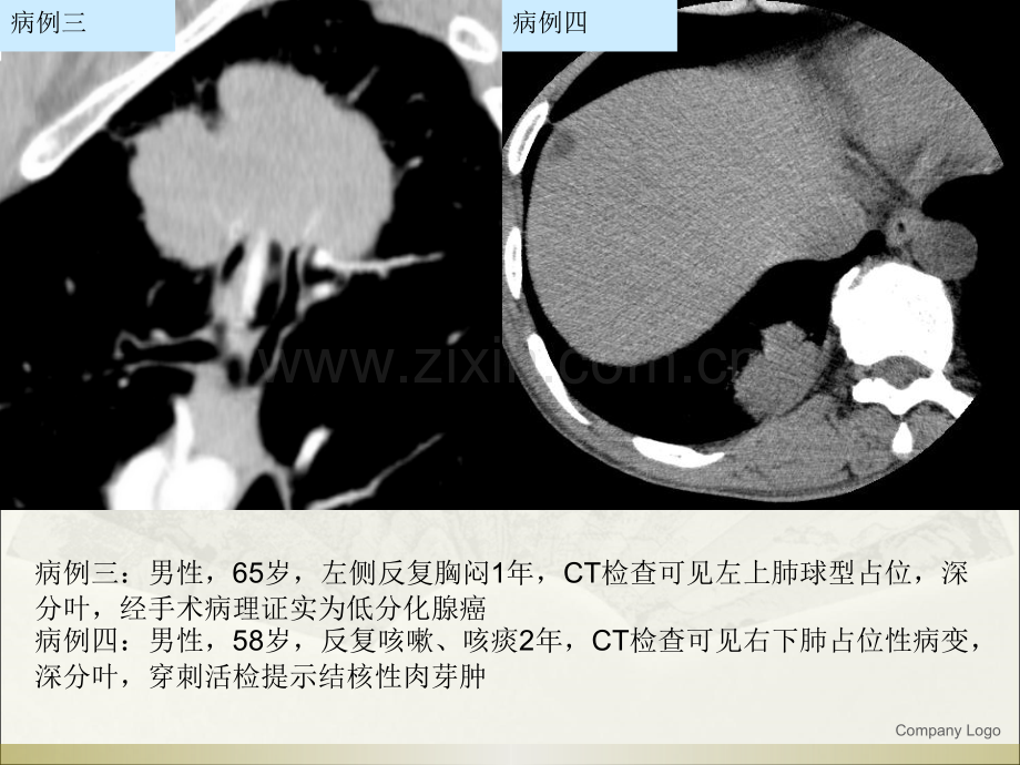 肺结核---球形结核的影像诊断与鉴别诊断ppt课件.ppt_第3页