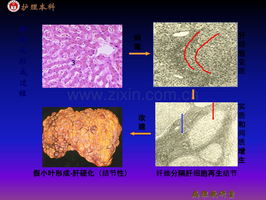 病理学肝硬化肝癌ppt课件.ppt_第2页