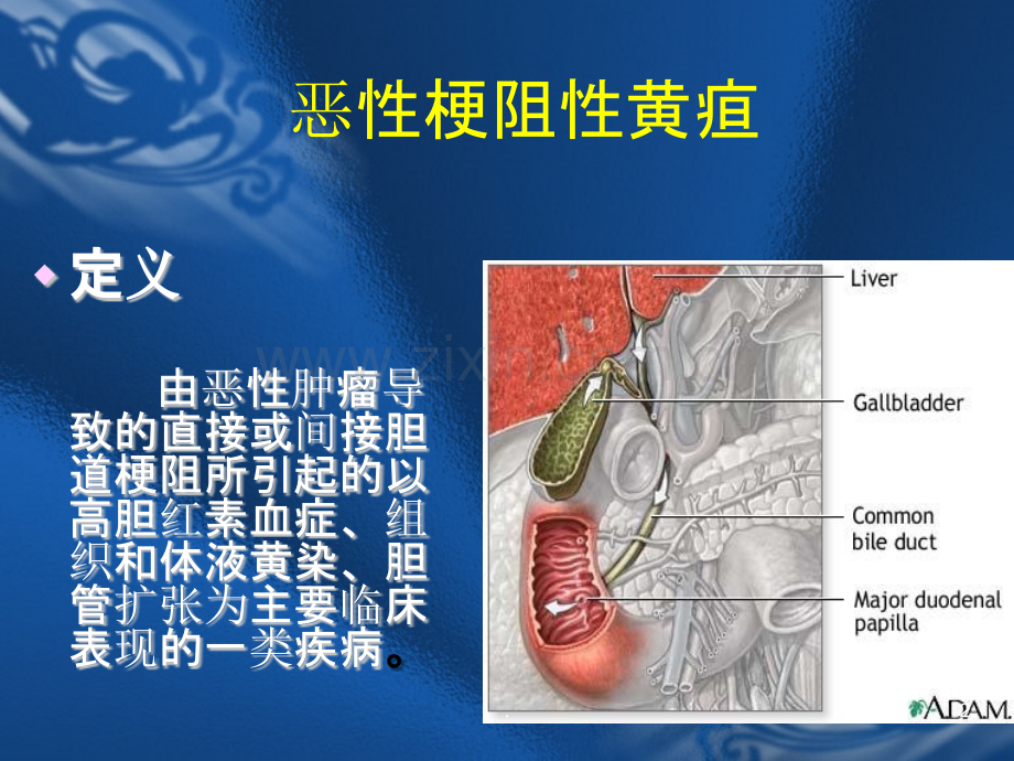 恶性梗阻性黄疸.ppt_第2页