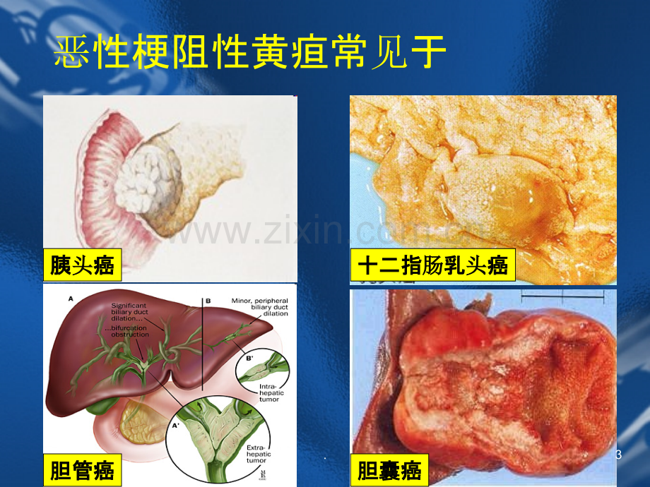 恶性梗阻性黄疸.ppt_第3页