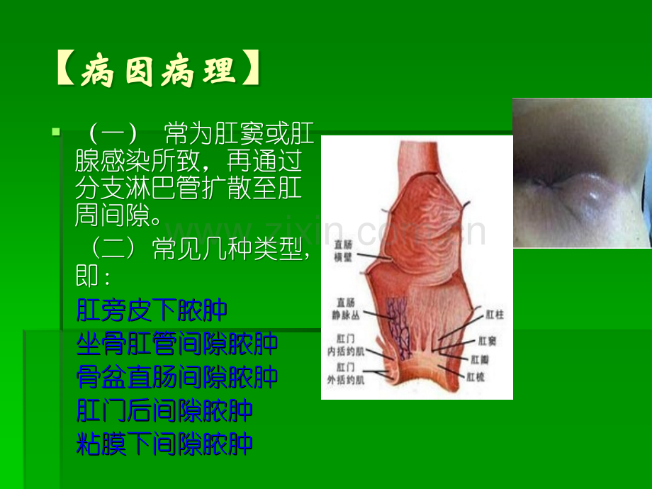 肛周常见病课件ppt课件.ppt_第3页