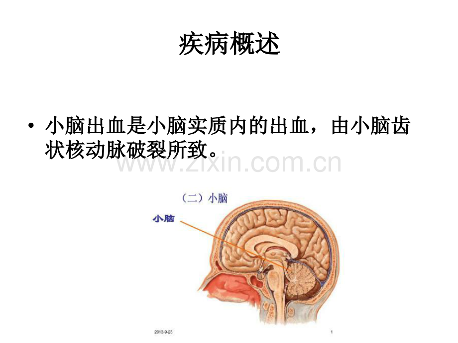 小脑出血护理查房31987.ppt_第3页