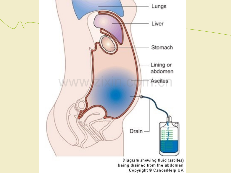 腹腔穿刺术及护理ppt课件(1).ppt_第3页