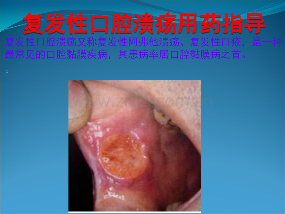 复发性口腔溃疡用药指导.ppt_第1页