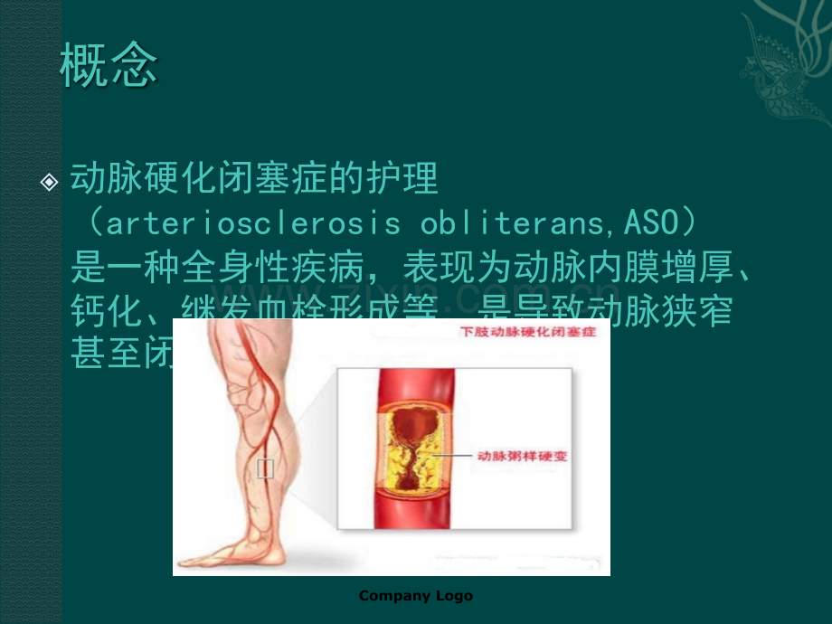 动脉硬化闭塞症的护理ppt课件.ppt_第3页