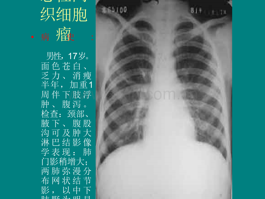 肺癌诊断1肺癌诊断.ppt_第2页