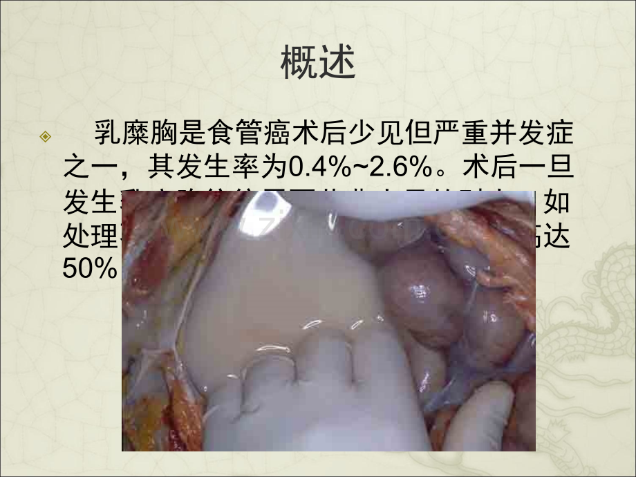 食管癌术后并发乳糜胸的护理ppt课件.ppt_第2页