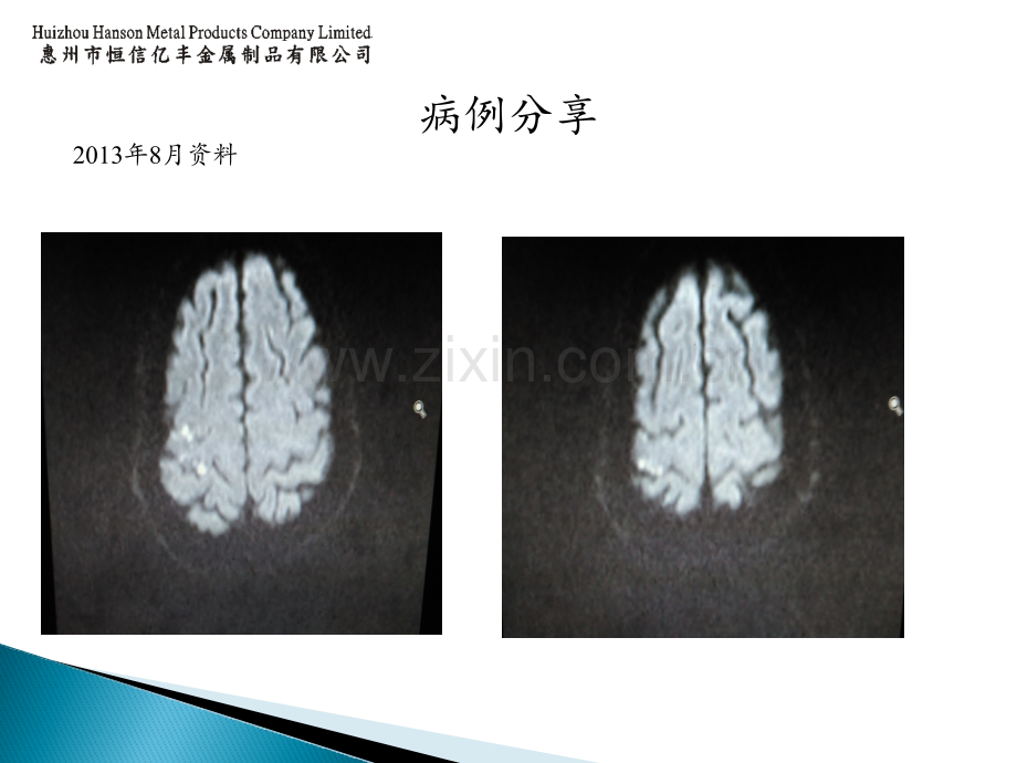 Trousseau综合征ppt课件.pptx_第2页