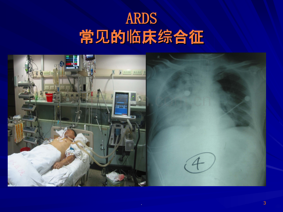 ARDS的治疗策略ppt课件.ppt_第3页