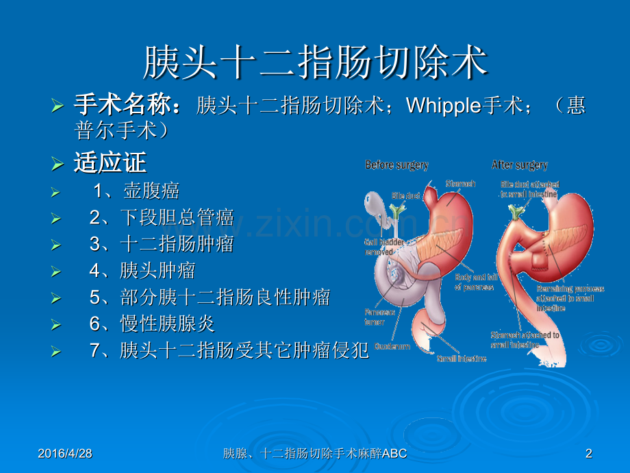 胰腺、十二指肠手术麻醉ABC--鲁彦斌ppt课件.pptx_第2页