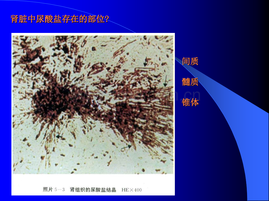 痛风的中西医结合诊治进展南方医院中医内科钟洪.ppt_第3页