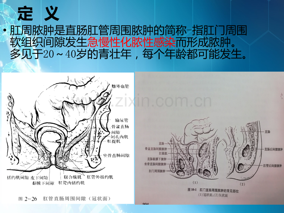 肛周脓肿课件ppt课件.ppt_第3页