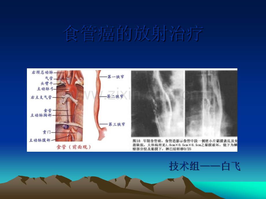 食管癌的放射治疗ppt课件.pptx_第1页