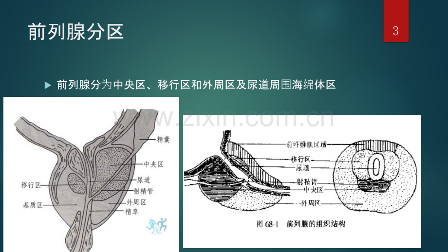 BPH手术指征ppt课件.pptx_第3页