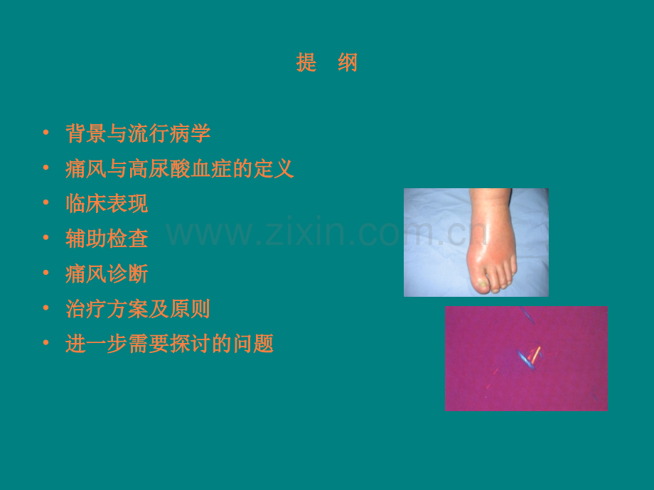 中国痛风临床诊治指南解读ppt.ppt_第2页