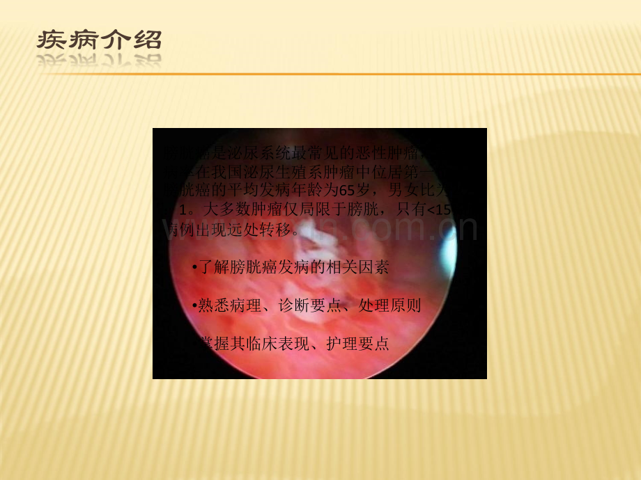 膀胱癌的护理.ppt_第2页