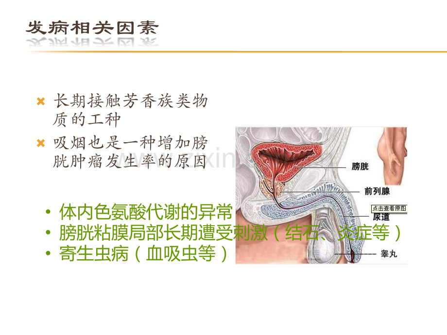 膀胱癌的护理.ppt_第3页