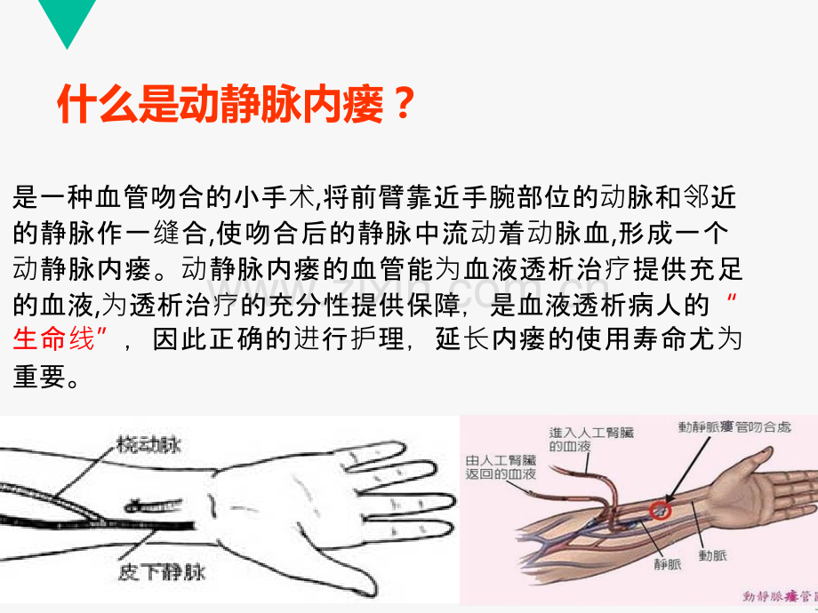 动静脉内瘘的围手术期护理.ppt_第3页