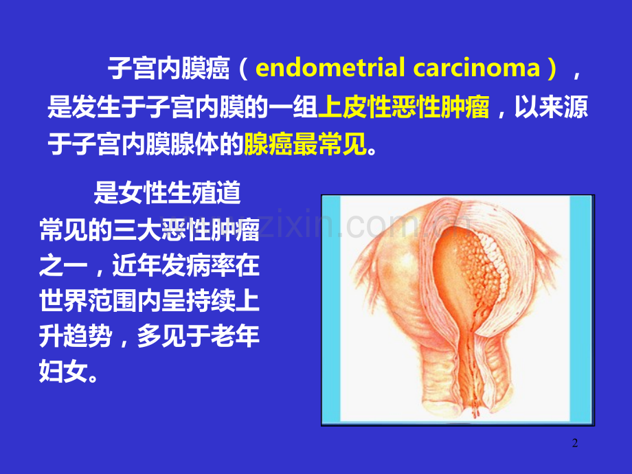 子宫内膜癌PPT课件.ppt_第2页