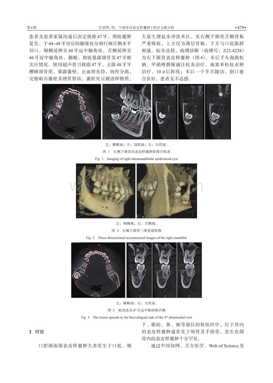 下颌骨内表皮样囊肿1例及文献分析.pdf_第2页