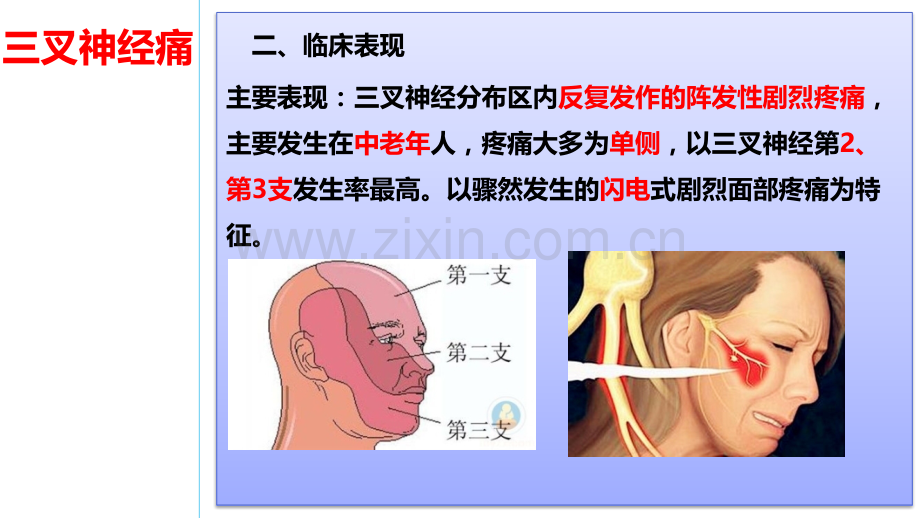 三叉神经痛病人的护理课件.pptx_第3页