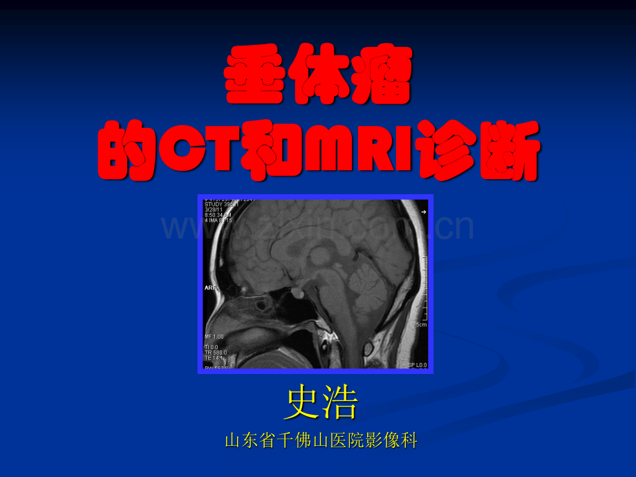 垂体瘤的CT和MRI诊断.pdf_第1页