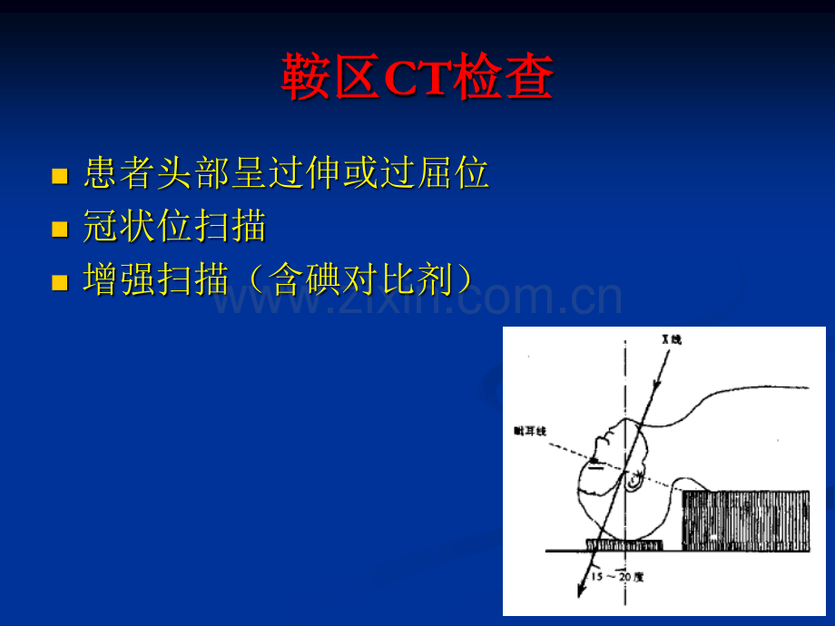 垂体瘤的CT和MRI诊断.pdf_第3页