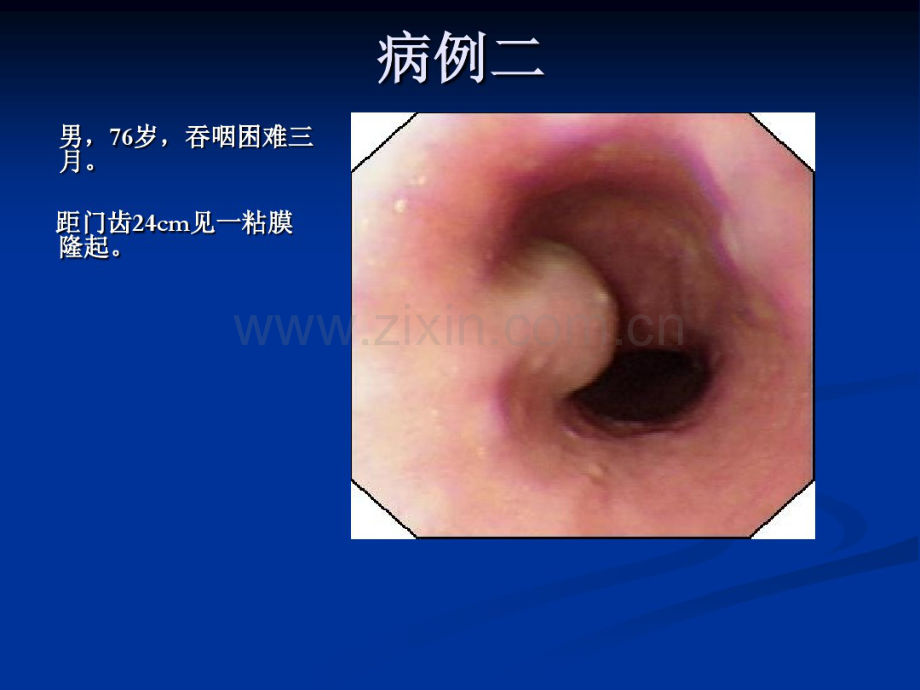 消化道黏膜隆起性病变的超声内镜诊断.pdf_第3页