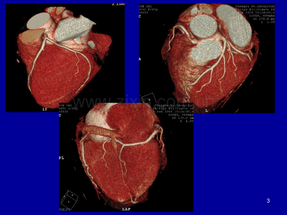 冠状动脉CTA成像ppt课件.ppt_第3页
