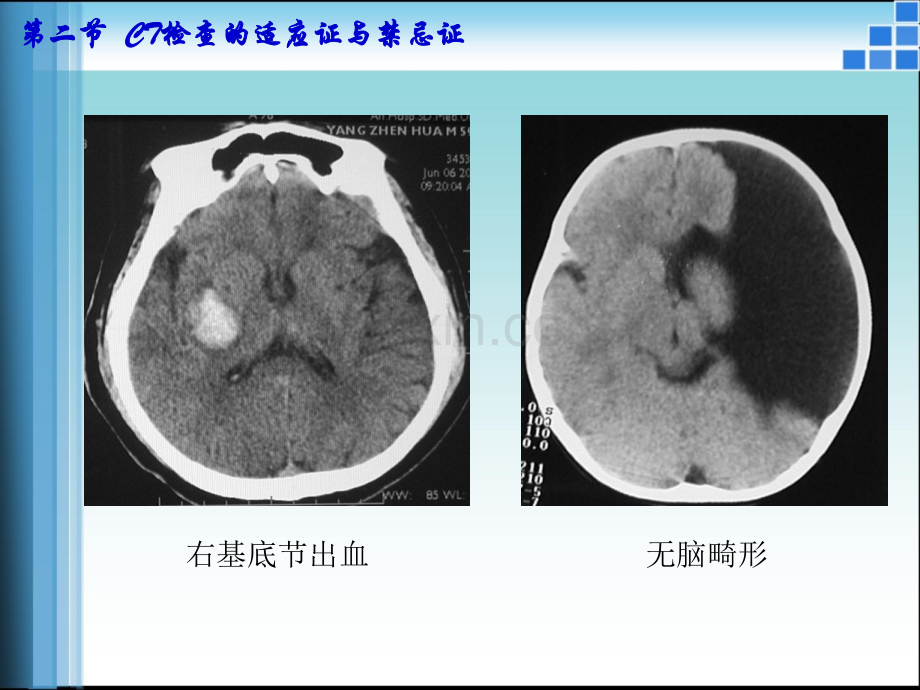 CT检查的适应证与禁忌证ppt课件.ppt_第3页