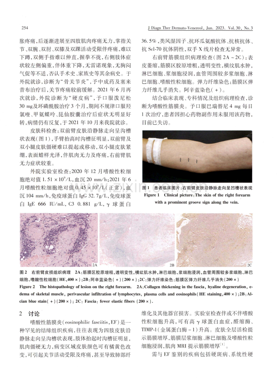 嗜酸性筋膜炎1例.pdf_第2页