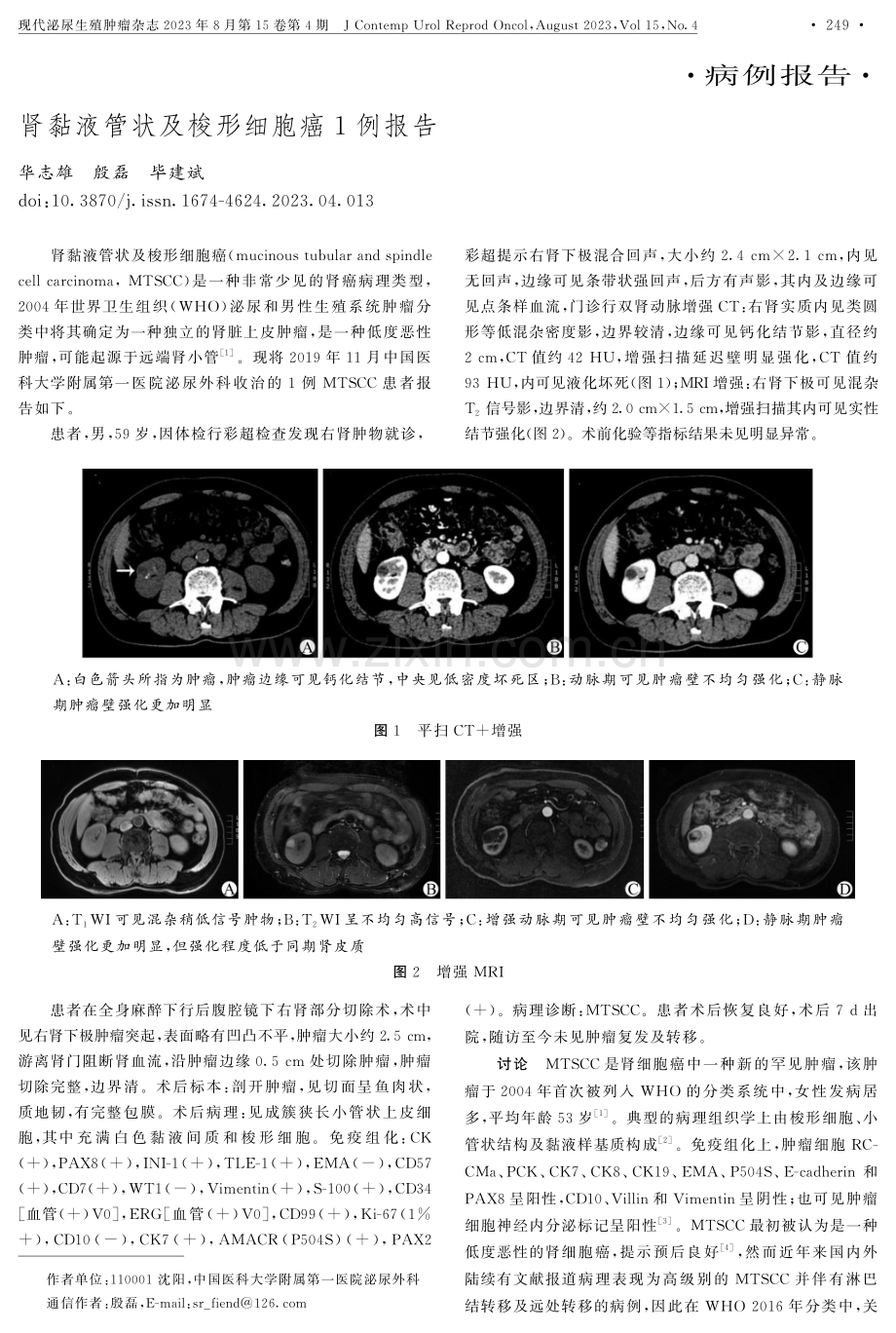 肾黏液管状及梭形细胞癌1例报告.pdf_第1页