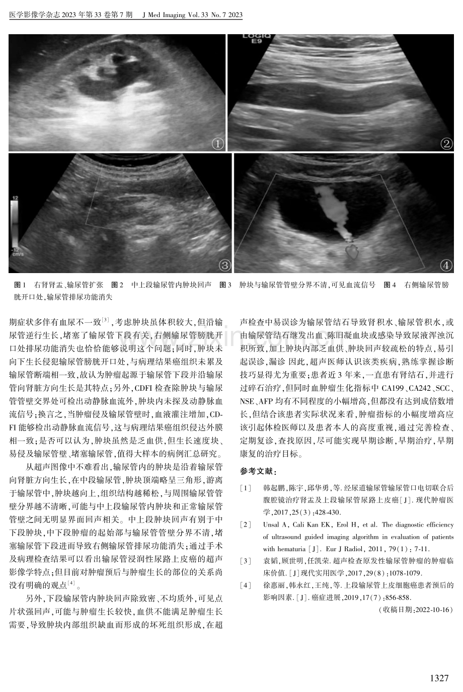 输尿管浸润性尿路上皮癌超声表现1例.pdf_第2页