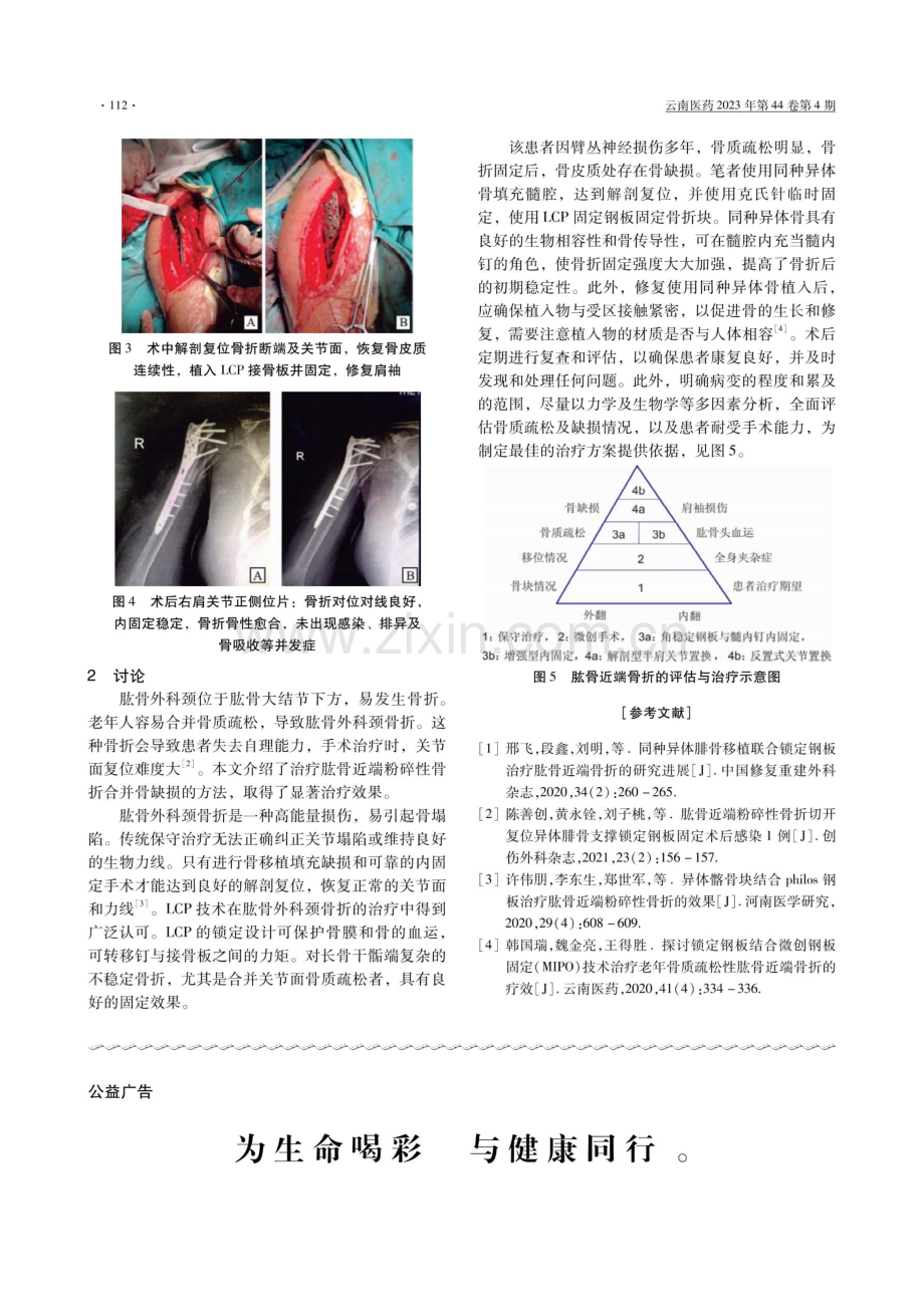 同种异体腓骨结合LCP治疗肱骨近端粉碎性骨折1例报道.pdf_第2页