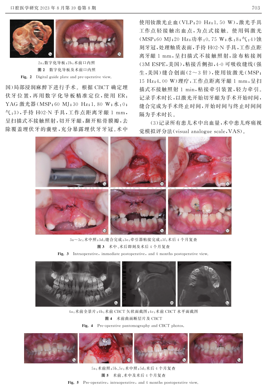 双波长激光结合数字化导板在上颌埋伏中切牙牵引中的随机对照研究.pdf_第3页