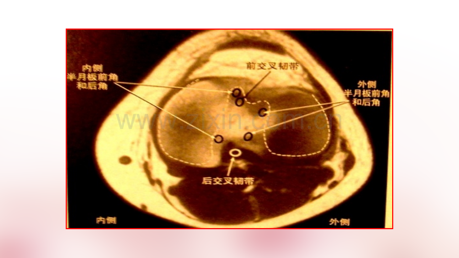 半月板损伤的磁共振表现ppt课件.ppt_第3页