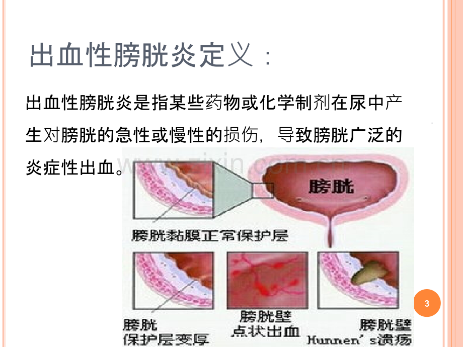 化疗所致出血性膀胱炎的护理ppt课件.pptx_第3页