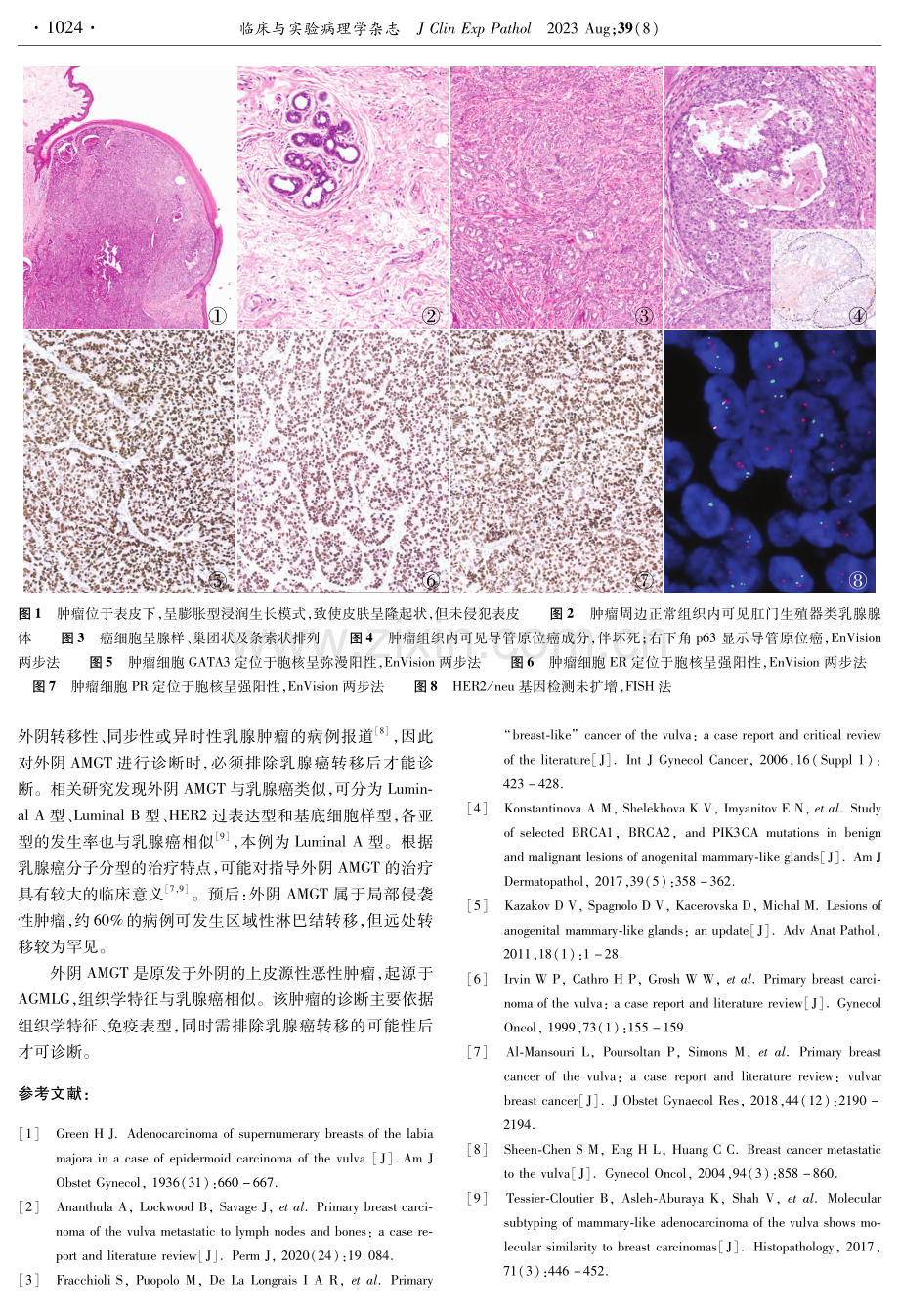 外阴乳腺型腺癌1例.pdf_第2页