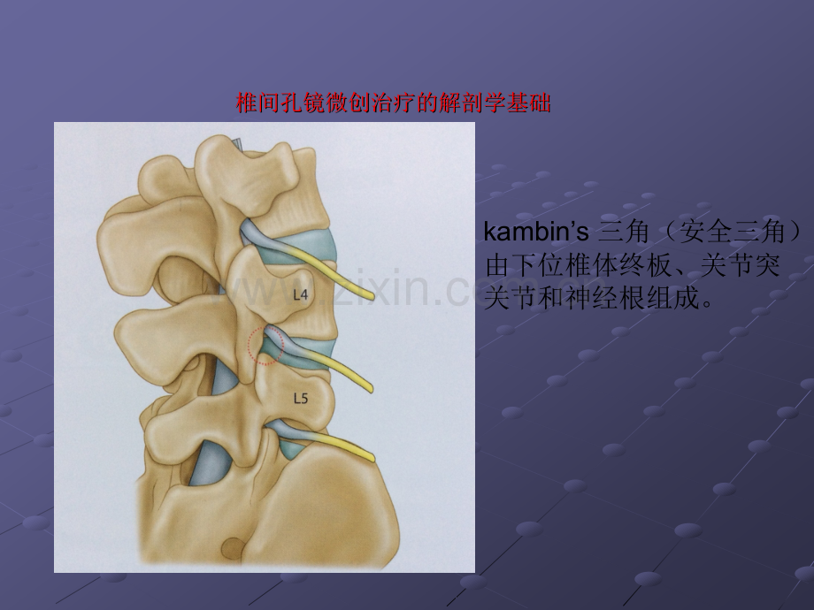 侧路椎间孔镜治疗L5S1椎间盘突出的经验分享ppt课件.ppt_第2页